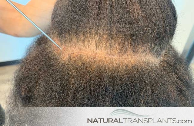 Natural Transplants, Hair Restoration Clinic gallery photo