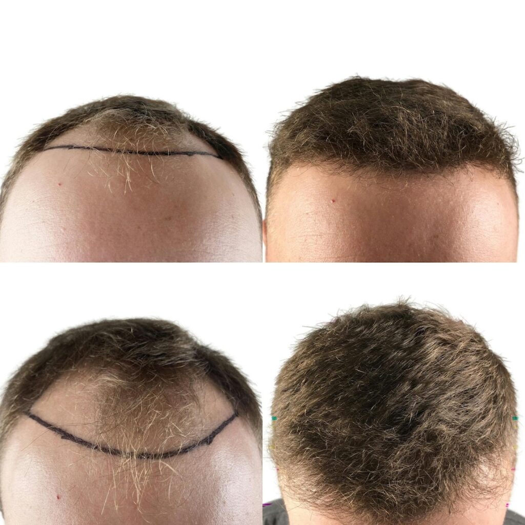 Maxim Hair Restoration & Transplants – Philadelphia gallery photo