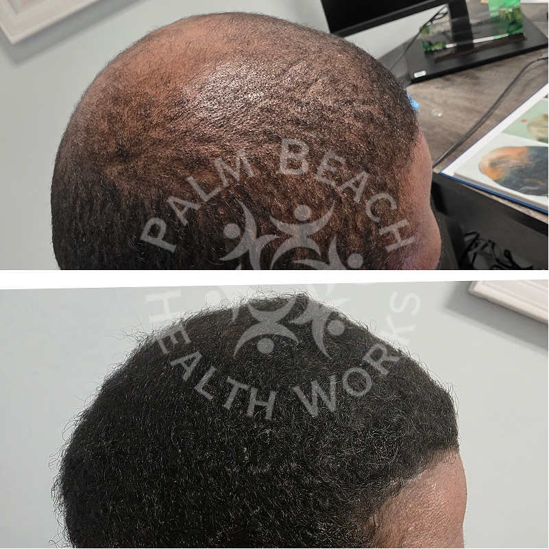 Palm Beach HealthWorks – Hair Replacement | Joint Pain Therapy | Wellness & Weight Loss | TRT Therapy gallery photo