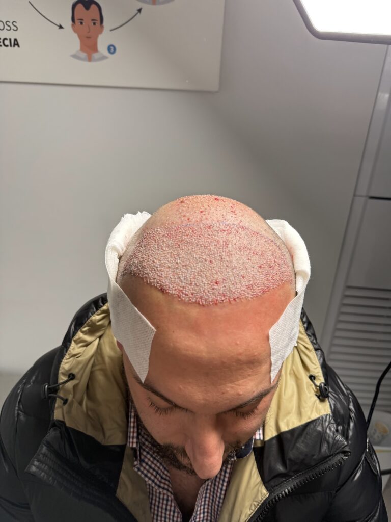 Major Clinic Italia – Albania – Hair Transplant gallery photo