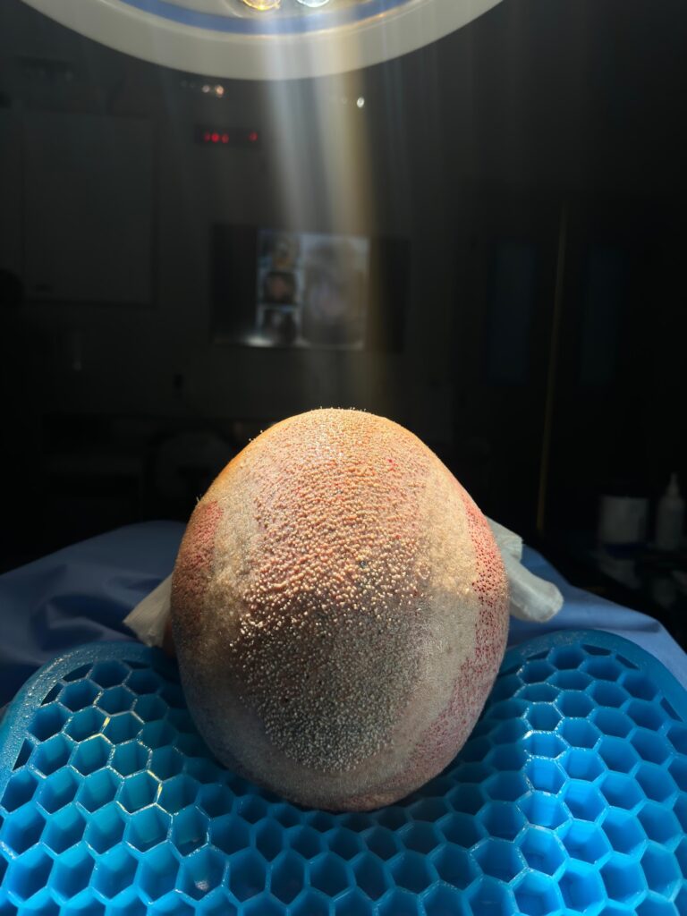 Dr. Gustavo Amarante – Transplante Capilar gallery photo