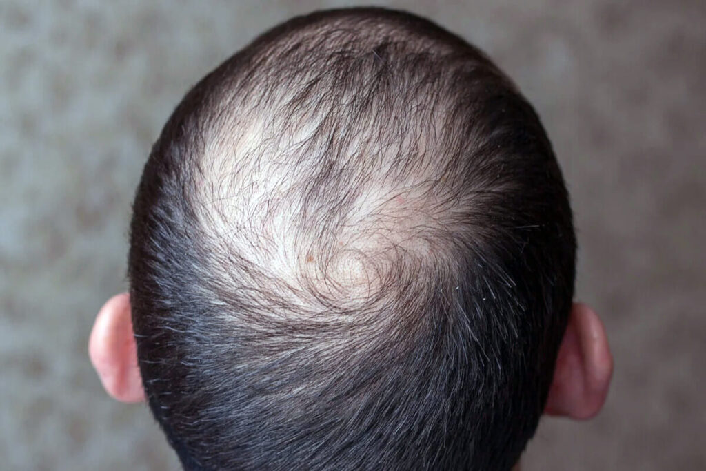 MedPrime Clinic – Hair Transplant Vancouver gallery photo