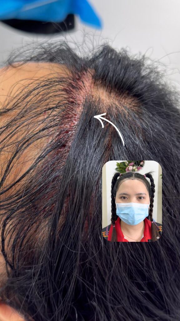 iGraft Long Hair FUE gallery photo
