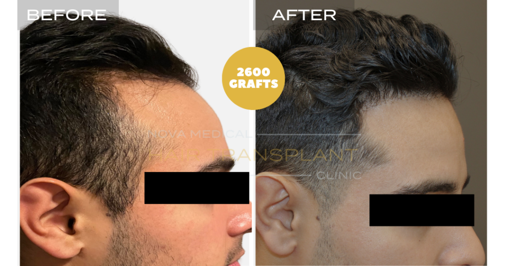 Hair Transplant Nashville | Nova Medical gallery photo