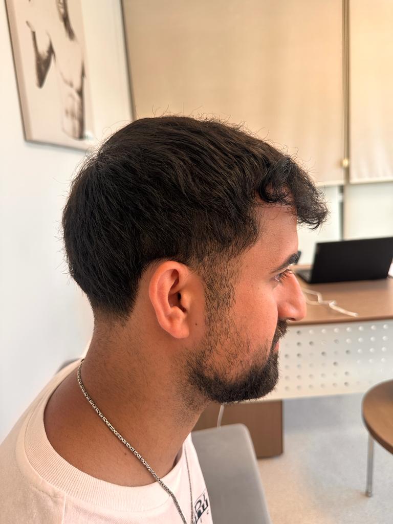 Bilyana Hair Transplant gallery photo