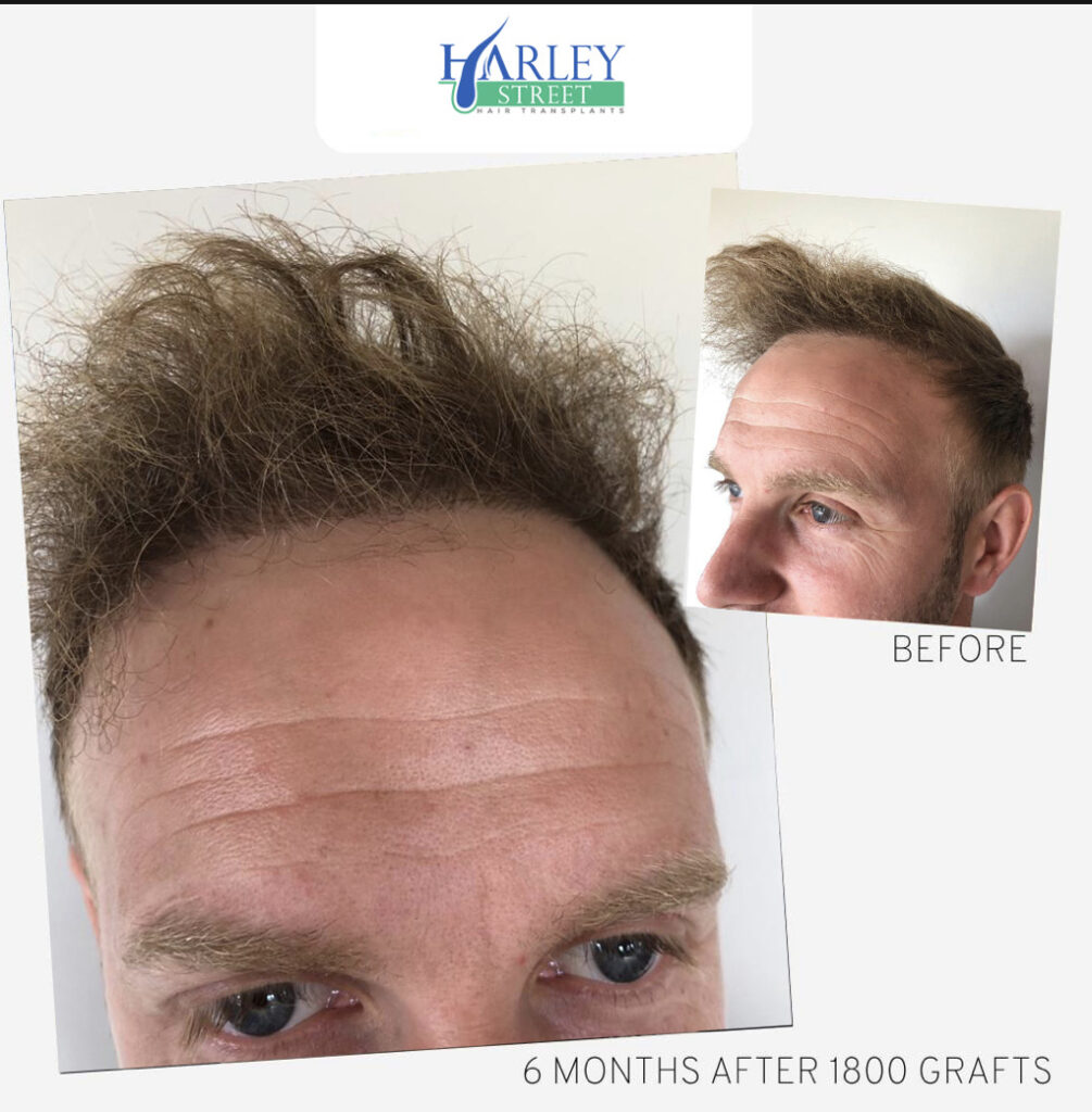 Manchester Hair Transplants Clinics gallery photo