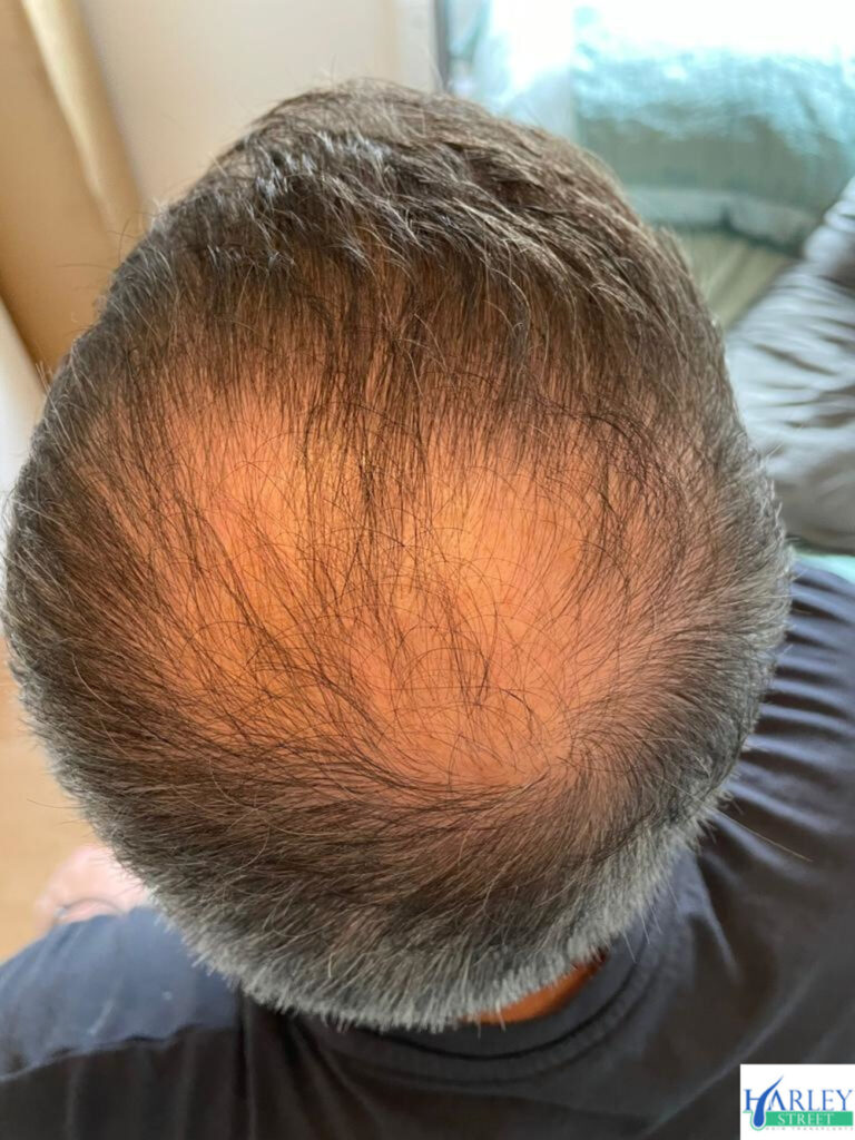 Manchester Hair Transplants Clinics gallery photo