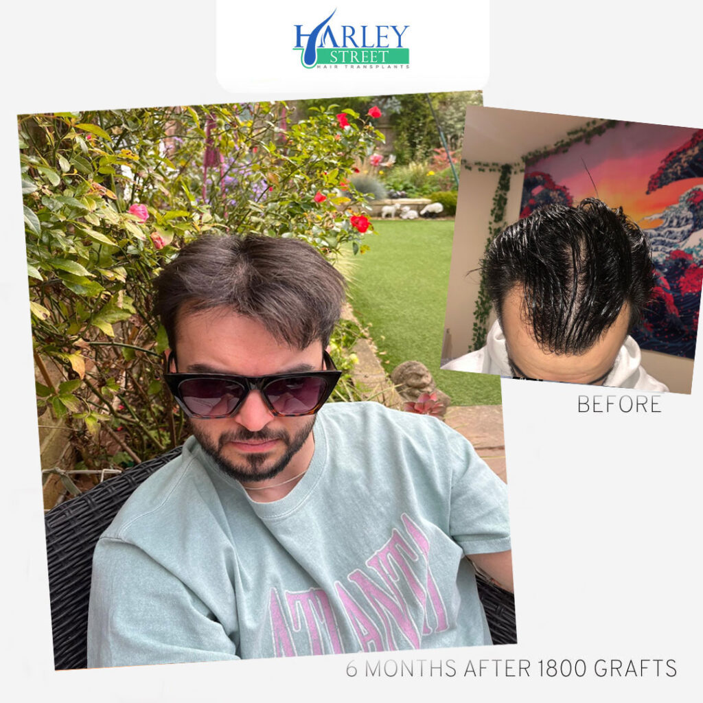 Manchester Hair Transplants Clinics gallery photo