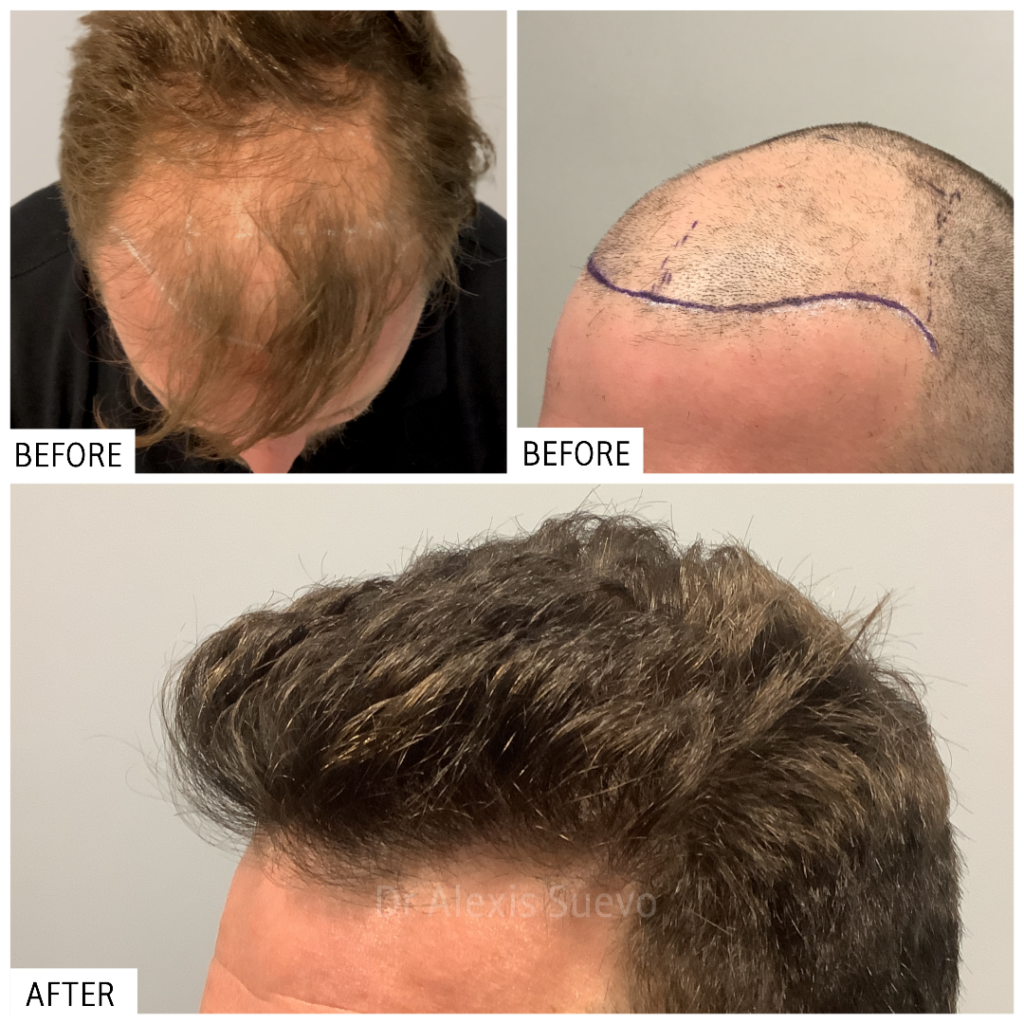ANAGEN Clinic | Hair Transplant Doctor Melbourne gallery photo