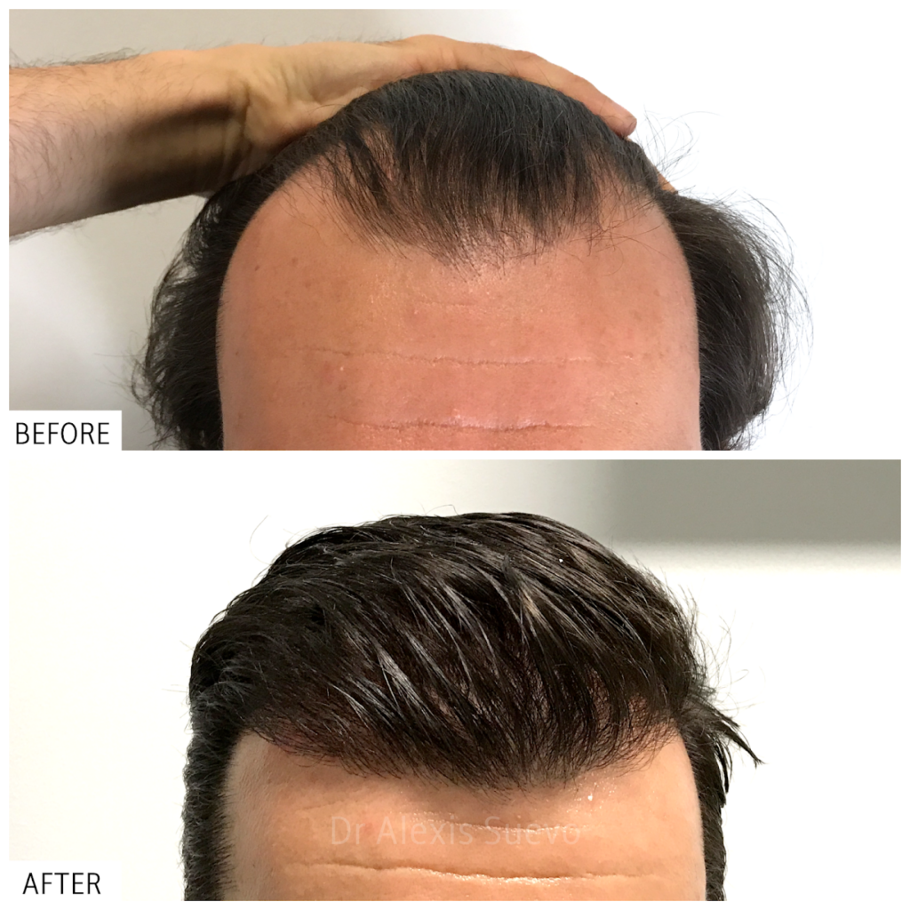 ANAGEN Clinic | Hair Transplant Doctor Melbourne gallery photo