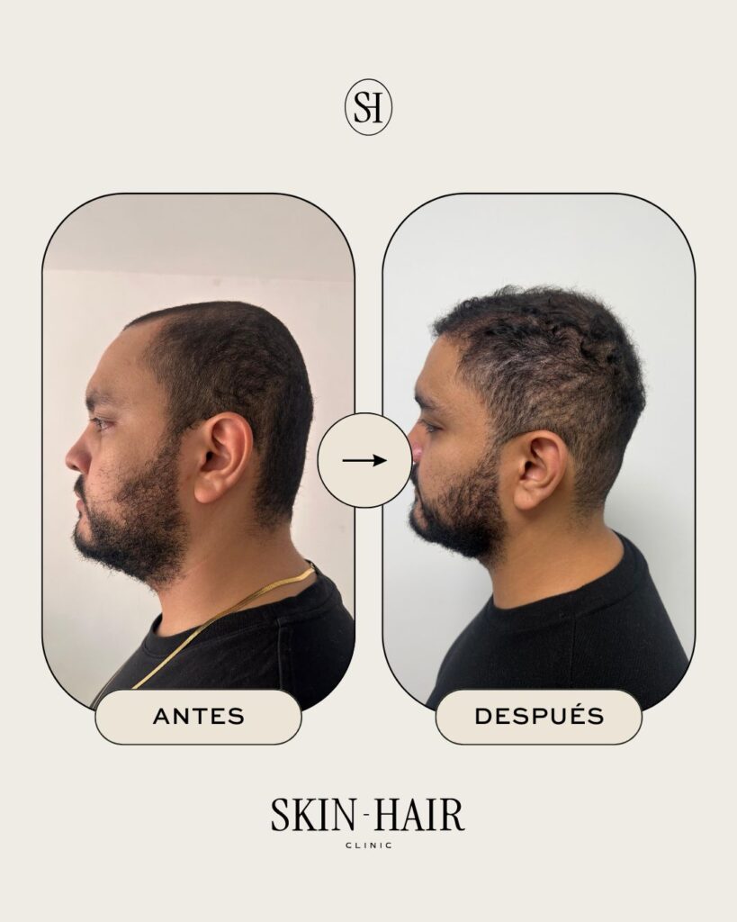 Skin Hair Clinic- Hair Restoration Clinic-Hair Transplant Medellin-Trasplante Capilar Medellin-Beard-PRP Hair-FUE-DHI-Botox gallery photo