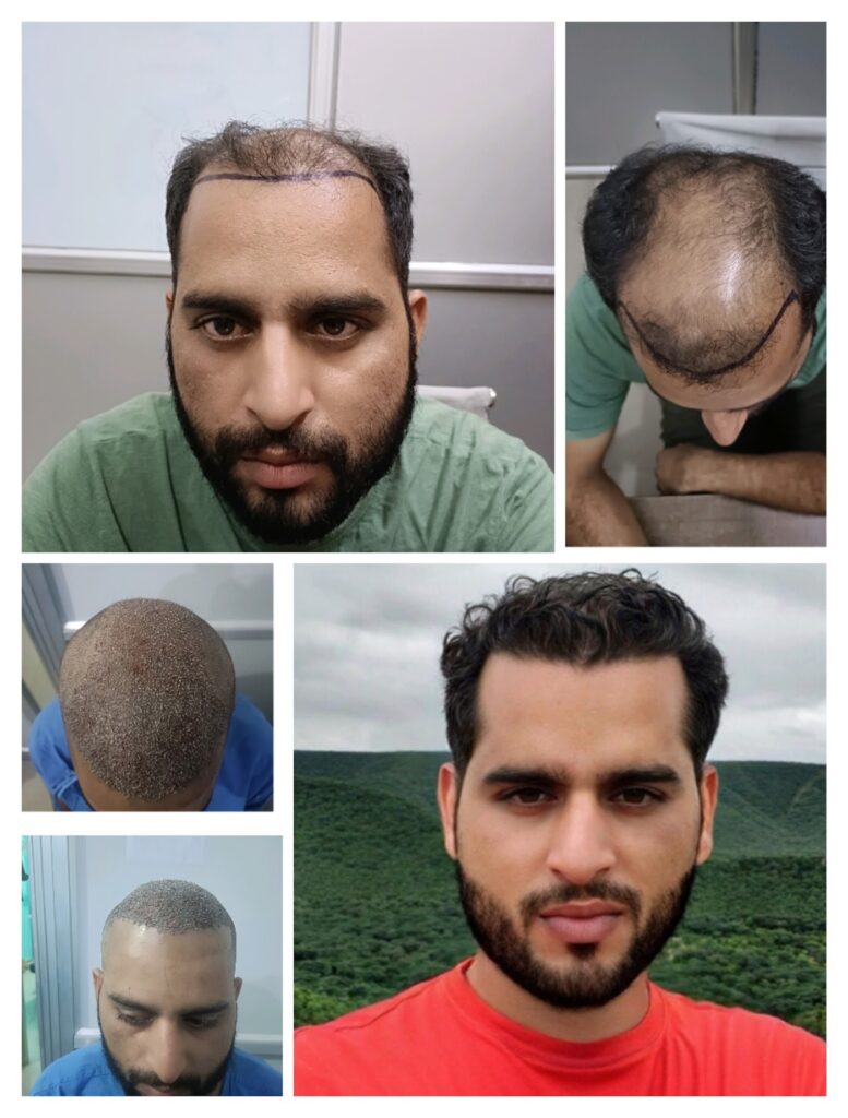 New hair cosmetic centre Best hair transplant, Best hair patch, gfc, prp, hair wigs in Jaipur gallery photo