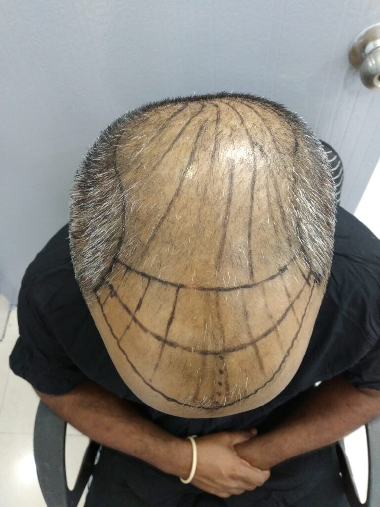 Anagen Hair Transplant Clinic : Natural Hairline | Baldness Treatment Best Hair Transplant Clinic in Mumbai gallery photo