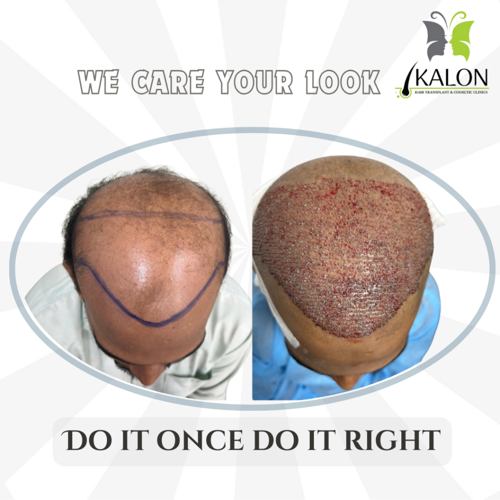 Kalon Hair Transplant & Cosmetic Clinics gallery photo