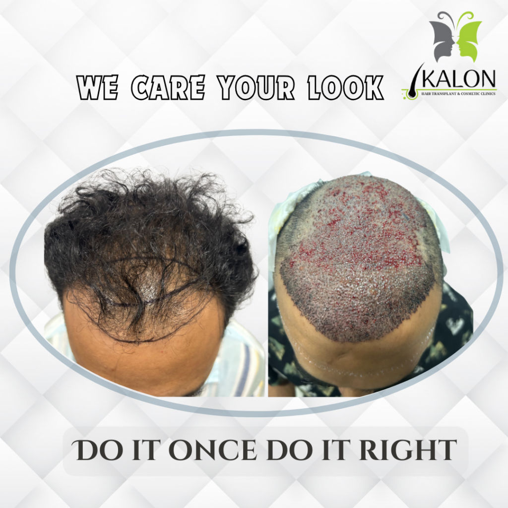 Kalon Hair Transplant & Cosmetic Clinics gallery photo