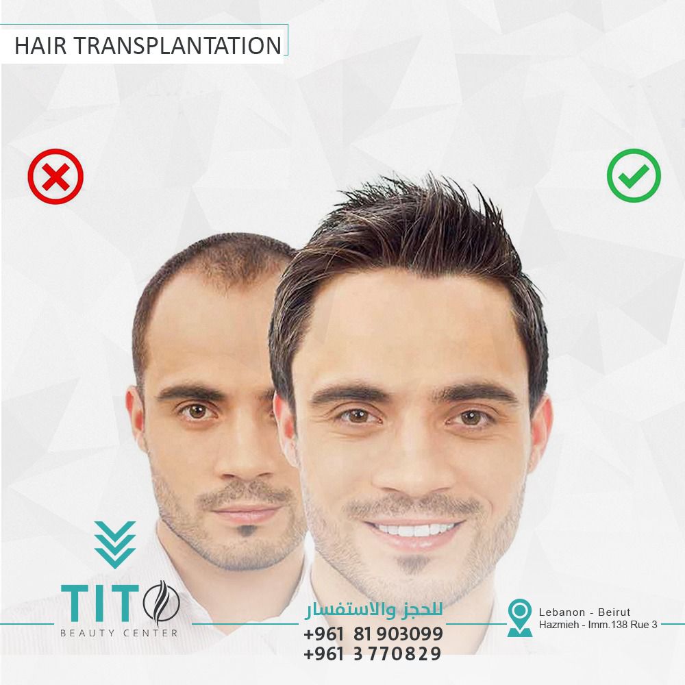 Hair transplant tito center gallery photo