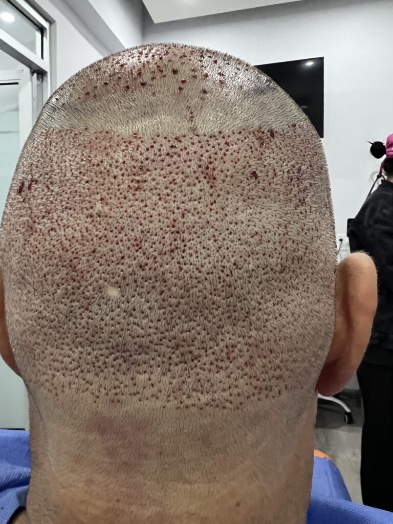 HairMex Hair Transplant Clinic gallery photo