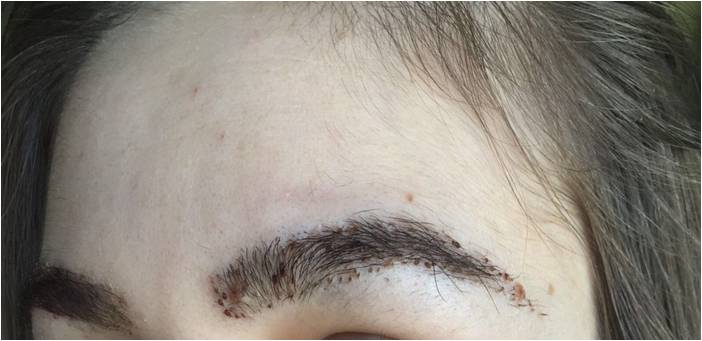 Transplant de păr – Hair transplant Bucuresti gallery photo