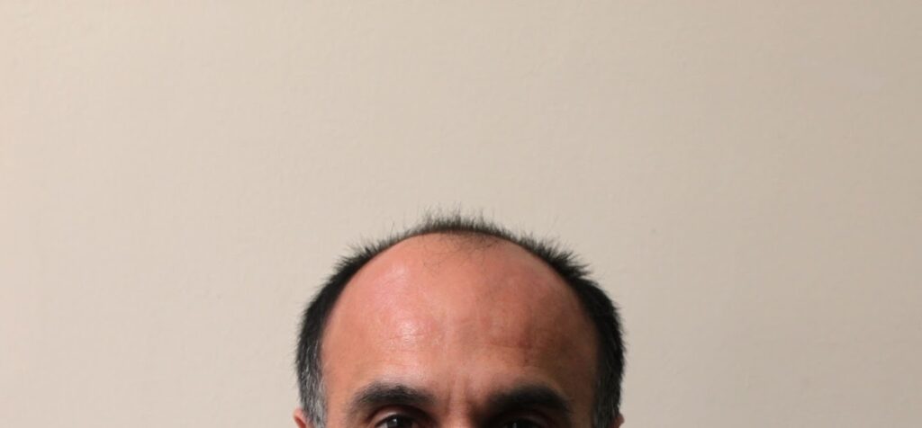 Transplant de păr – Hair transplant Bucuresti gallery photo