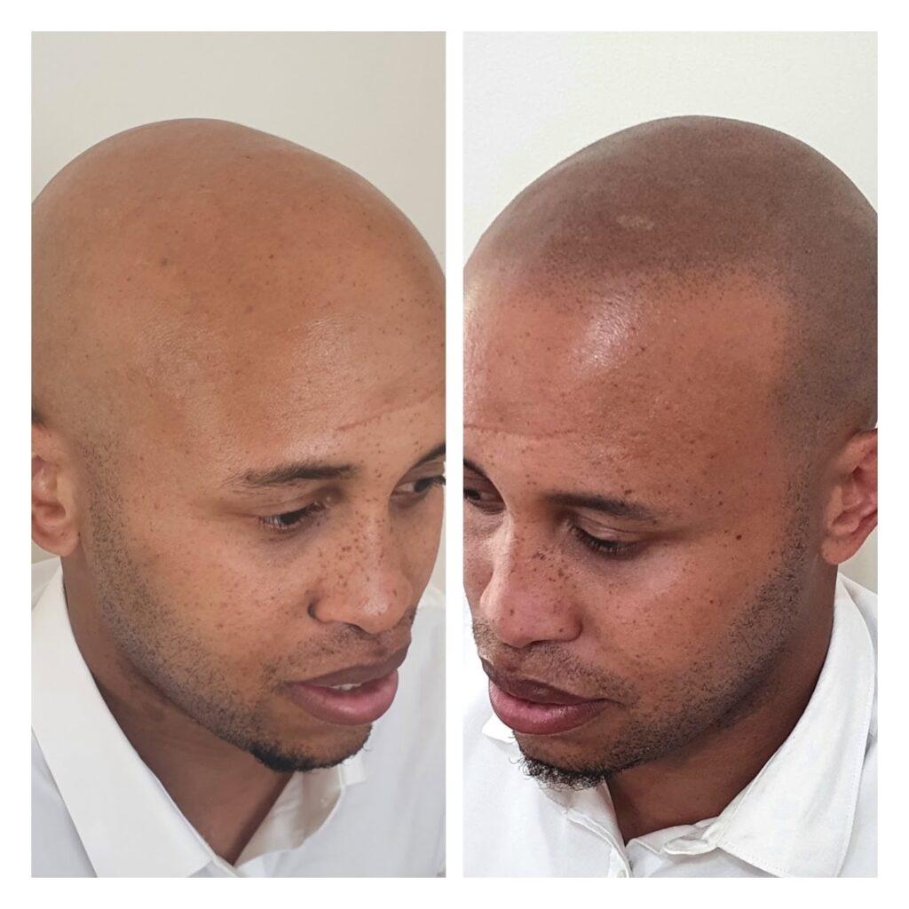 Hilton Hair SMP Clinic gallery photo