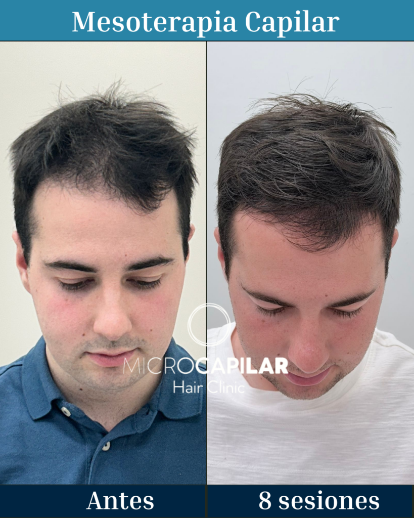 MicroCapilar Hair Clinic | Clínica Injerto Capilar Madrid gallery photo