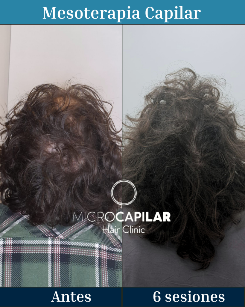 MicroCapilar Hair Clinic | Clínica Injerto Capilar Madrid gallery photo