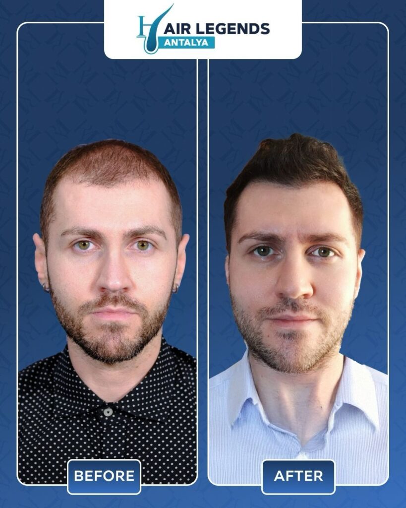 Hair Legends | Hair Transplant Antalya gallery photo