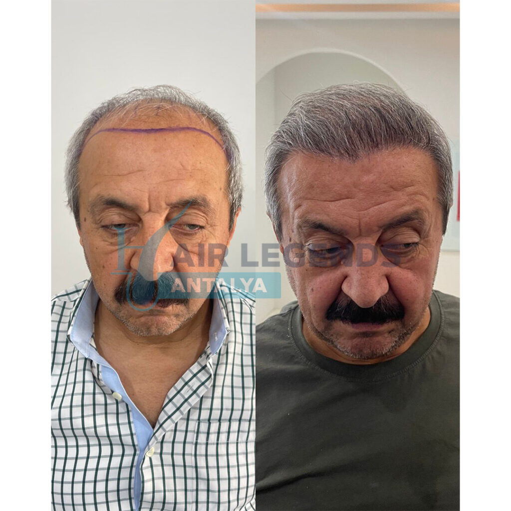 Hair Legends | Hair Transplant Antalya gallery photo