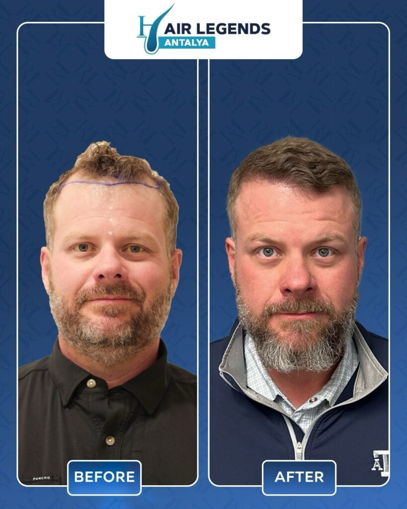 Hair Legends | Hair Transplant Antalya gallery photo