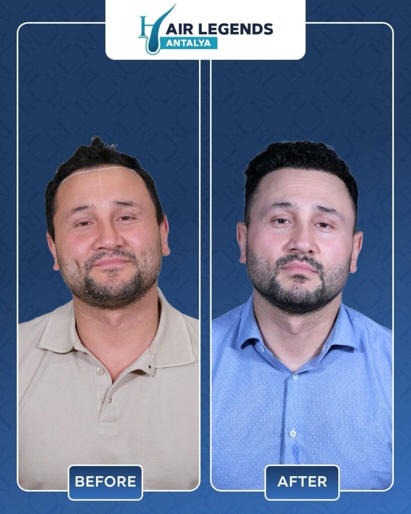Hair Legends | Hair Transplant Antalya gallery photo
