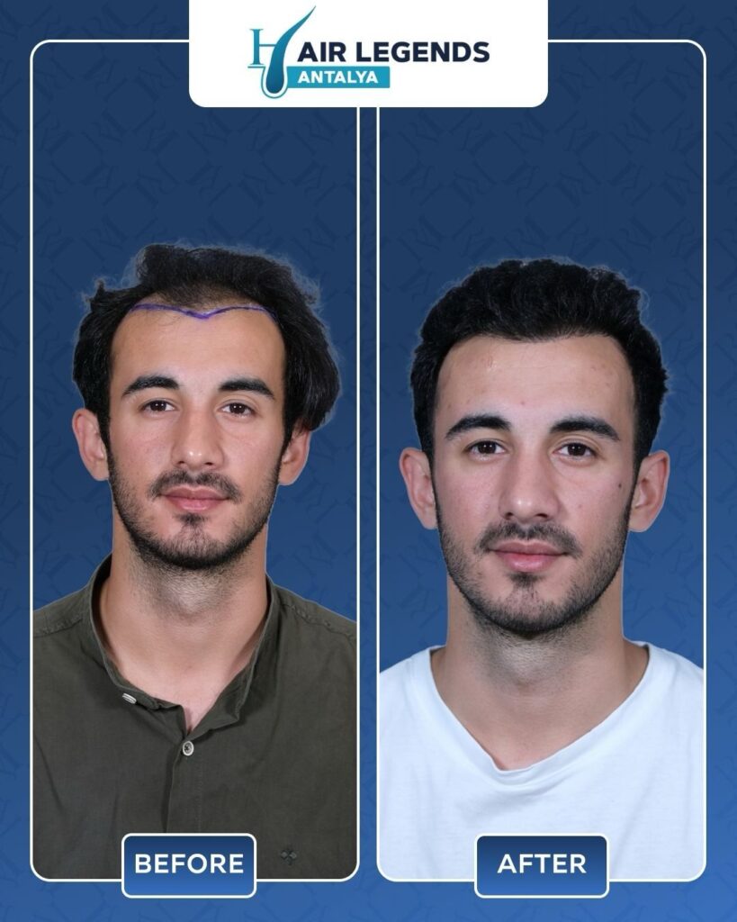Hair Legends | Hair Transplant Antalya gallery photo