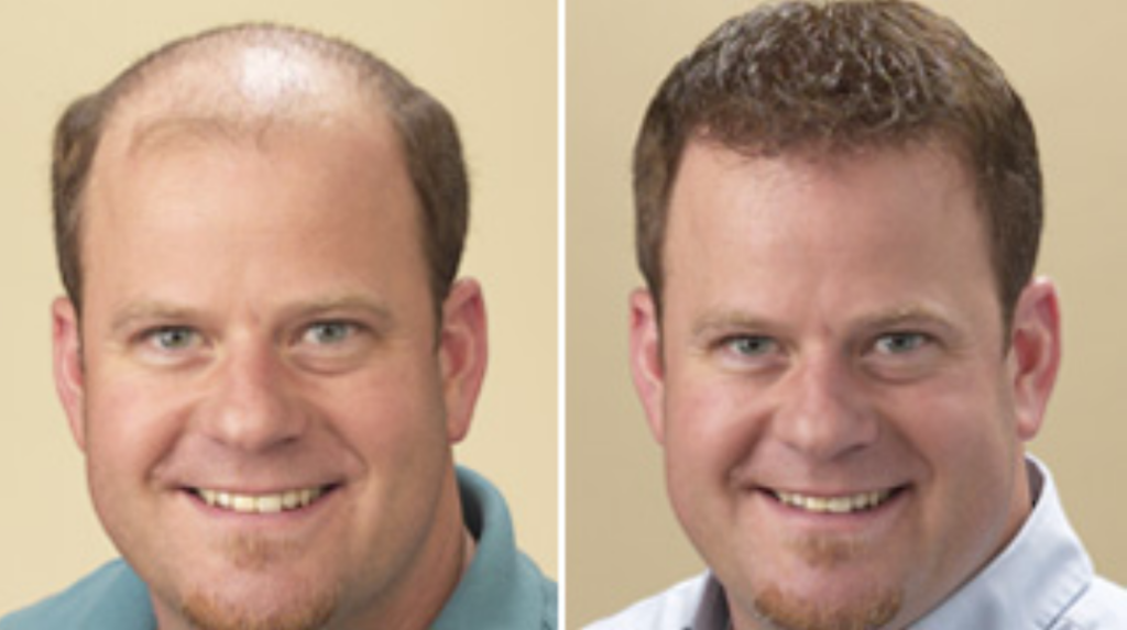 Wayne’s Concept Hair Replacement gallery photo