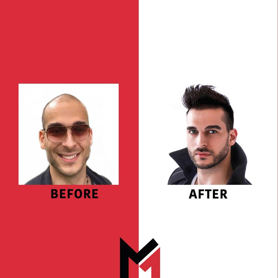 Maxim Hair Restoration & Transplants – New Jersey gallery photo