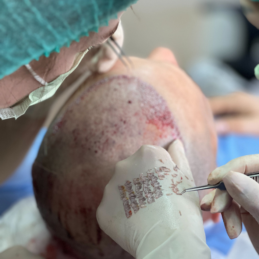 Nobi Hair Clinic | Trapianto Capelli Albania | Hair Transplant Albania gallery photo