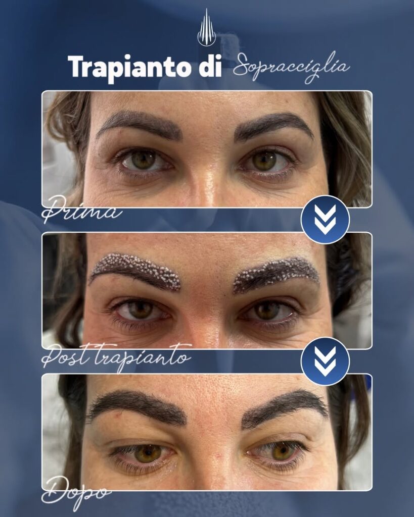 Nobi Hair Clinic | Trapianto Capelli Albania | Hair Transplant Albania gallery photo