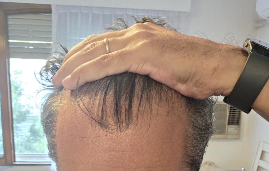 International Hair Clinics Argentina gallery photo