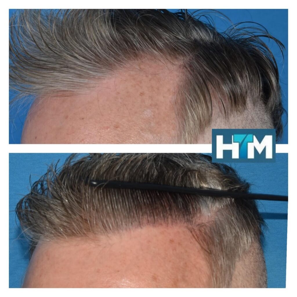 Hair Transplants Melbourne – Dr Paul Robinson & Spano gallery photo