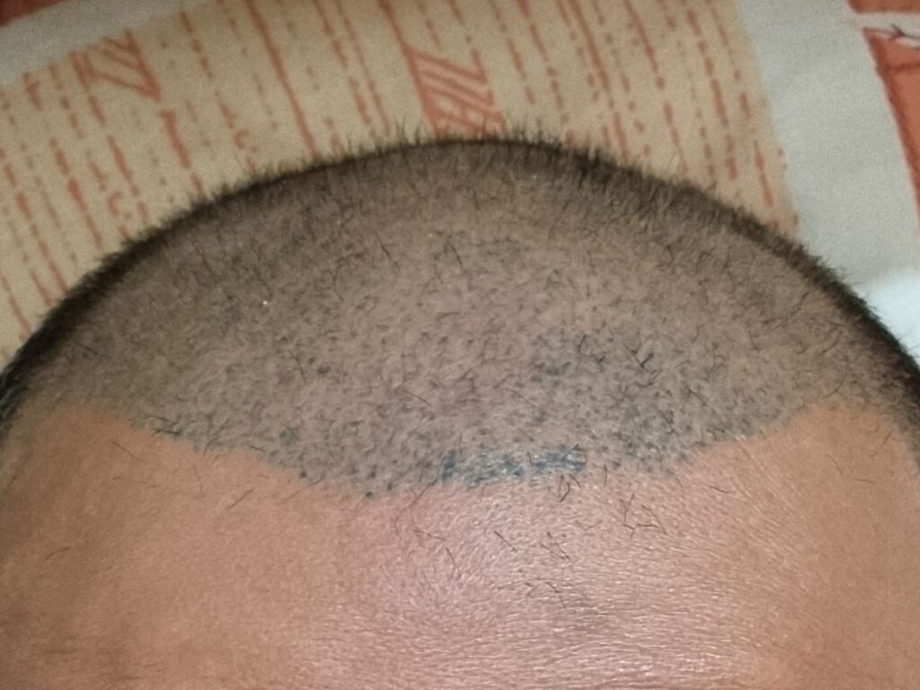 Neograft Hair Clinic gallery photo