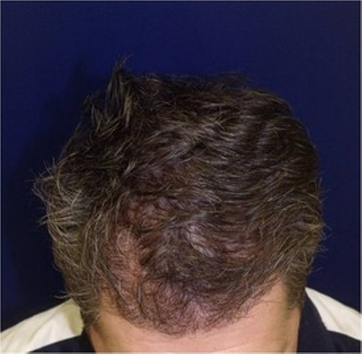 Chesapeake Hair Restoration – Hair Transplants in Baltimore, Maryland gallery photo