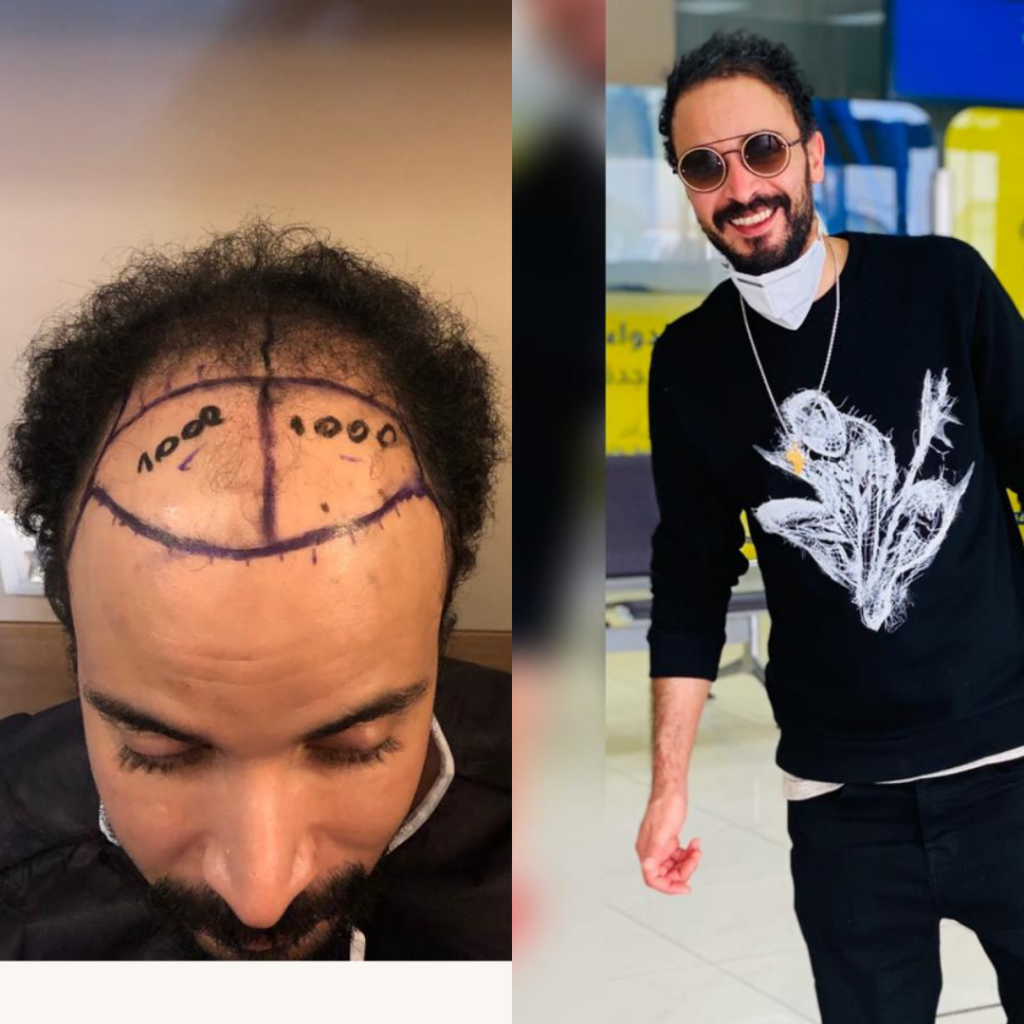 Maxim Hair Restoration & Transplants – Boca Raton gallery photo