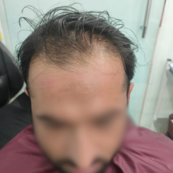 Hair Transplant Islamabad – Hairhub gallery photo