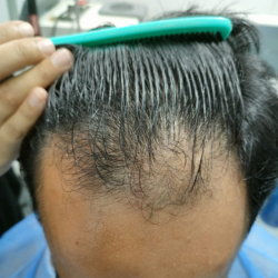 Hair Transplant Islamabad – Hairhub gallery photo
