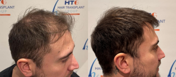 HTG Hair Transplant Group North London gallery photo