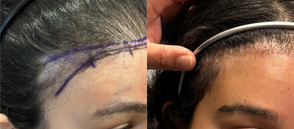 HTG Hair Transplant Group North London gallery photo