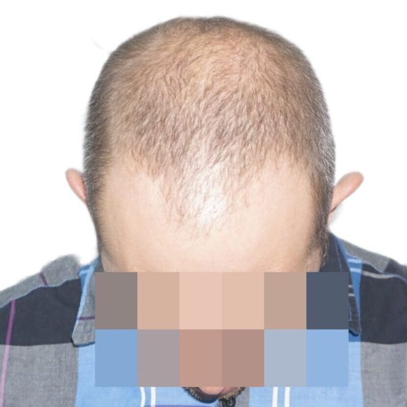 Marmedical – Trapianto Capelli Milano gallery photo