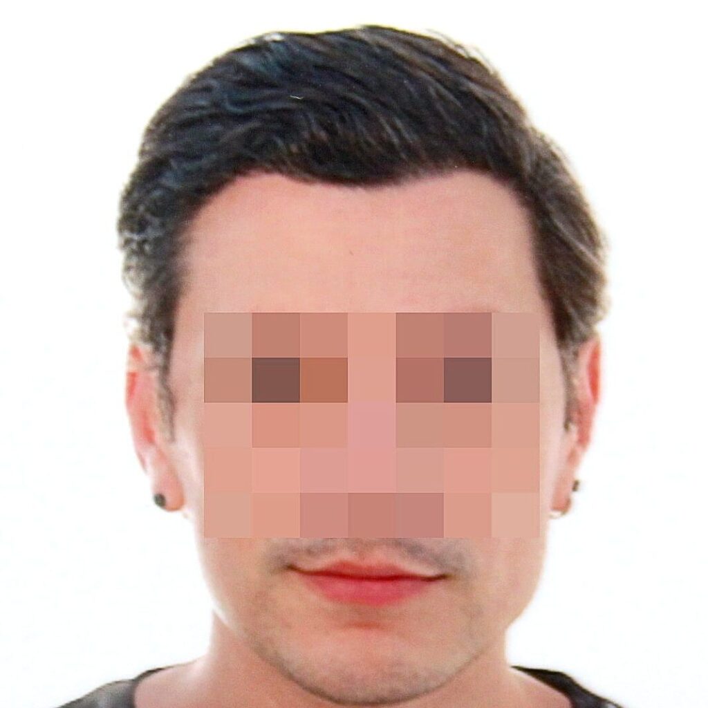 Marmedical – Trapianto Capelli Milano gallery photo