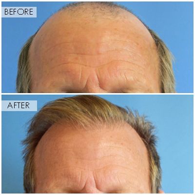 NeoGraft Hair Restoration Orange County gallery photo