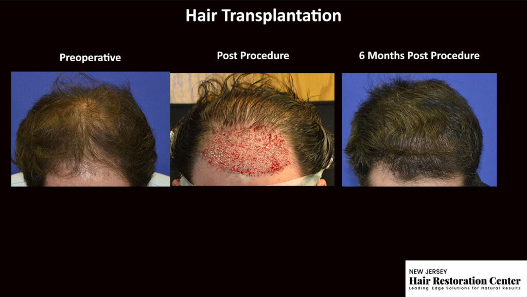 New Jersey Hair Restoration Center gallery photo