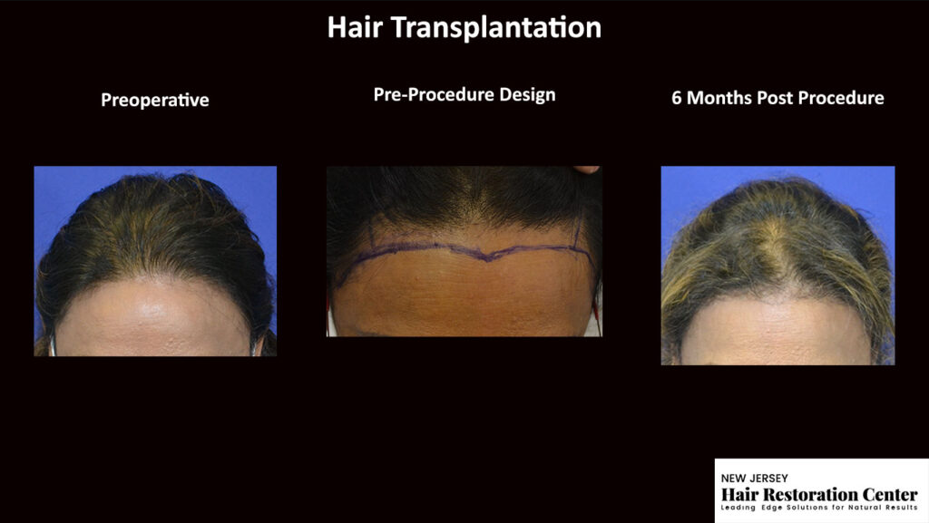 New Jersey Hair Restoration Center gallery photo
