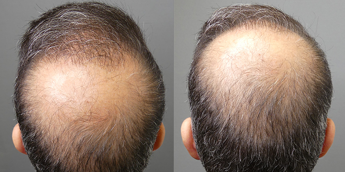 THE ANTIAGERS reGrow Hair Clinic Athens gallery photo